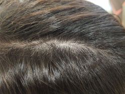 -碧莲盛·不剃发植发