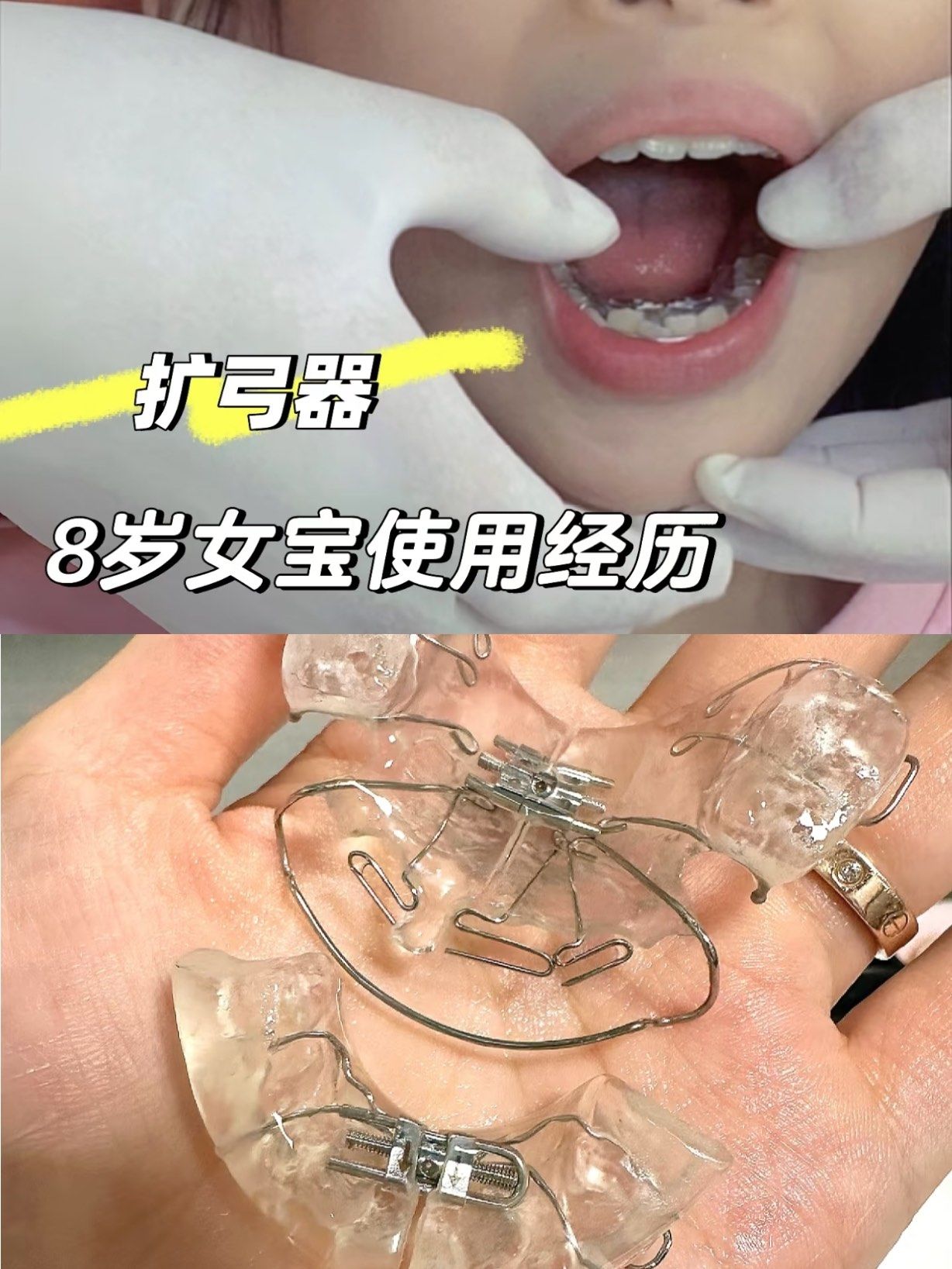 她聊起女儿正在做矫正,效果还不错,想着我家宝牙齿也需要矫正就多了解