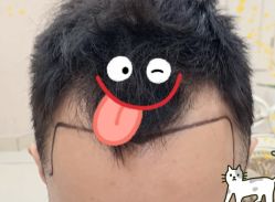 -大麦微针植发全国连锁