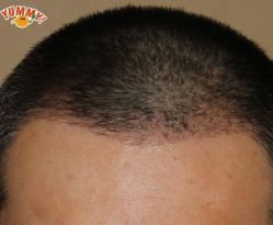 -大麦微针植发丨全国连锁