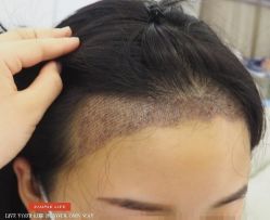 -大麦微针植发丨全国连锁