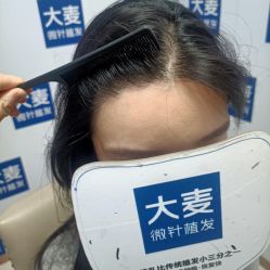 -大麦微针植发丨全国连锁
