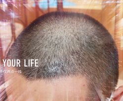 -大麦微针植发全国连锁