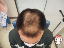 -大麦微针植发丨全国连锁