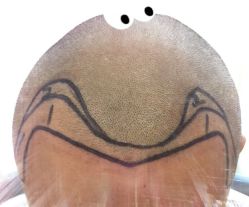 -大麦微针植发全国连锁