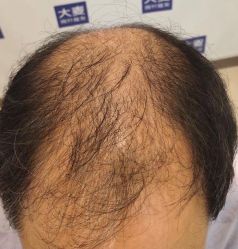 点击看大图 -大麦微针植发丨全国连锁