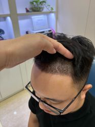 -大麦微针植发全国连锁