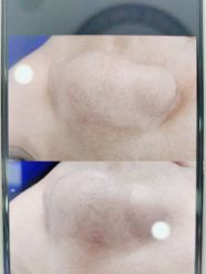 点击看大图 体验后-蕾特恩专业祛痘·皮肤管理