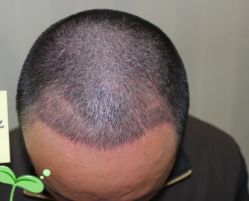 -大麦微针植发丨全国连锁