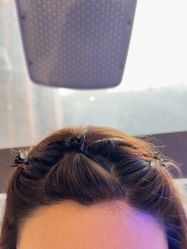 -碧莲盛·不剃发植发