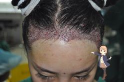 -大麦微针植发丨全国连锁