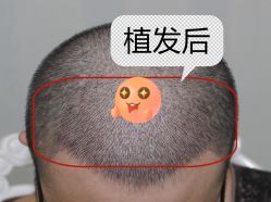 -大麦微针植发全国连锁