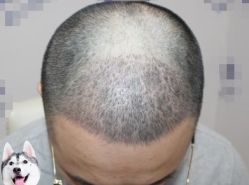 -大麦微针植发丨全国连锁