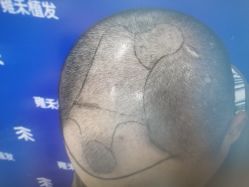 -雍禾植发全国连锁