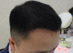 -大麦微针植发丨全国连锁