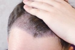 -大麦微针植发丨全国连锁