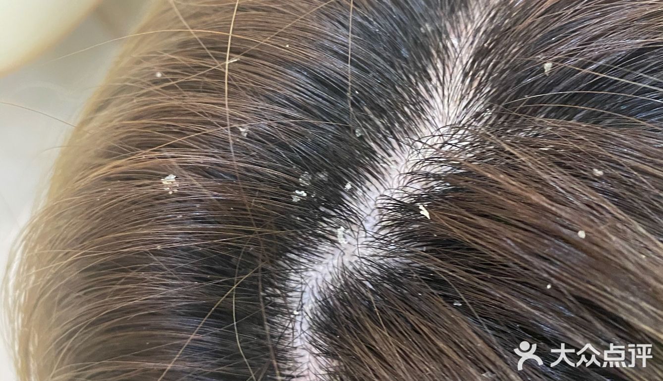 染发后的脂溢性皮炎