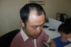 -大麦微针植发丨全国连锁