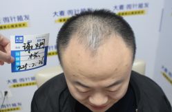 -大麦微针植发丨全国连锁
