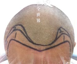 -大麦微针植发全国连锁