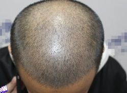 -大麦微针植发丨全国连锁