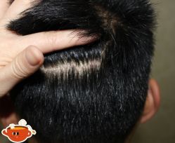 -大麦微针植发丨全国连锁