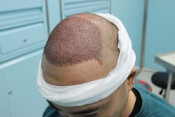 点击看大图 -大麦微针植发丨全国连锁