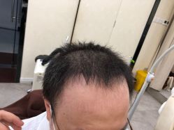 点击看大图 -大麦微针植发全国连锁