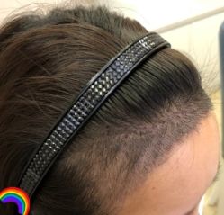 -大麦微针植发丨全国连锁