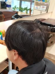 -碧莲盛·不剃发植发