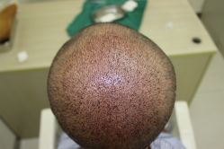 点击看大图 -大麦微针植发丨全国连锁