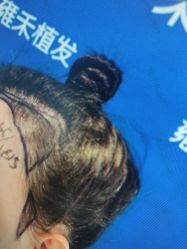 -雍禾植发全国连锁