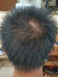 -碧莲盛·不剃发植发