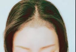 -大麦微针植发丨全国连锁