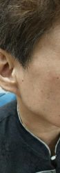 -北京美痣堂古方祛痣斑疣瘊