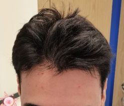 -大麦微针植发丨全国连锁