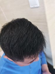 点击看大图 -大麦微针植发丨全国连锁