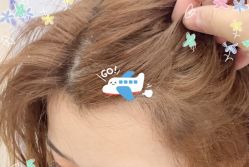 -大麦微针植发全国连锁