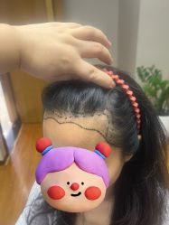 -大麦微针植发全国连锁