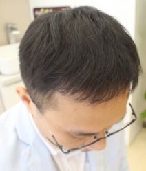 -大麦微针植发全国连锁