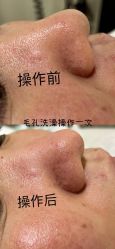 体验后-+MS卓美丝专业祛痘·皮肤管理中心