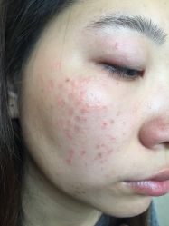 -美丽人生祛斑扁平疣汗管瘤中心
