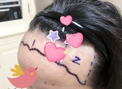 -大麦微针植发全国连锁