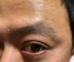 -北京美痣堂古方祛痣斑疣瘊