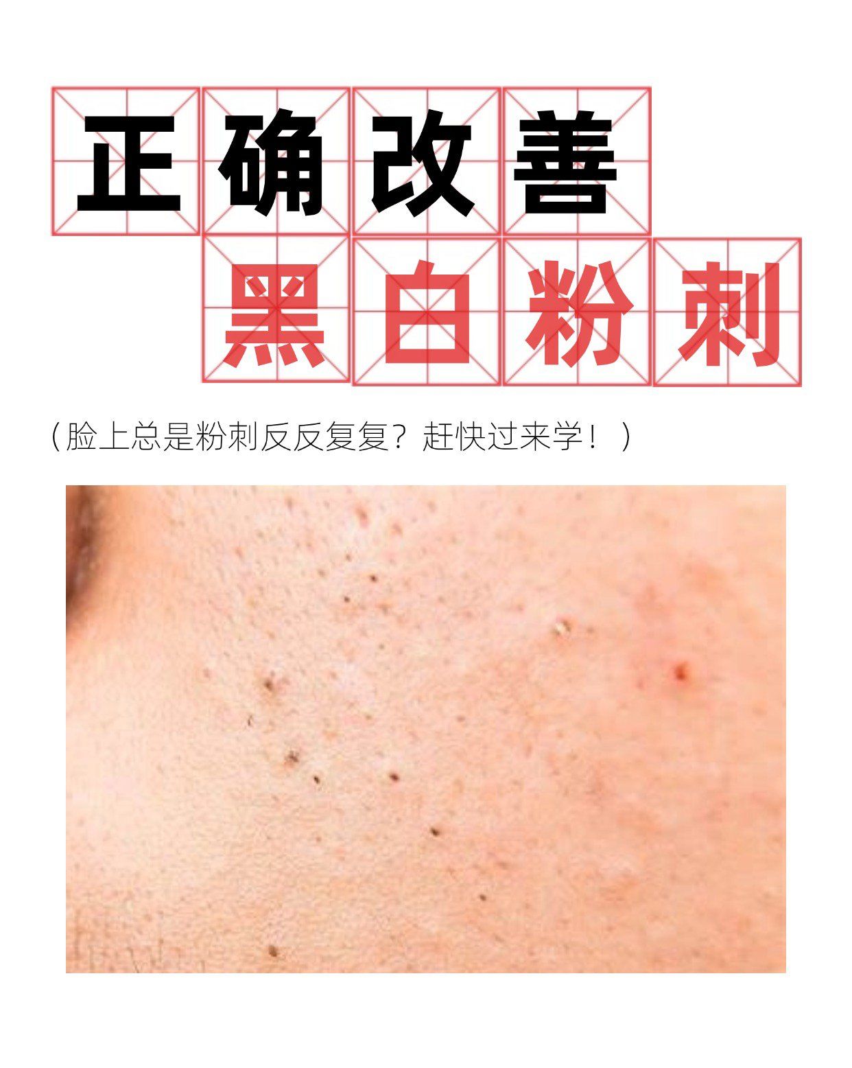 n
💡粉刺的类型:
①白头粉刺:
也被称为闭合性粉刺或壁口