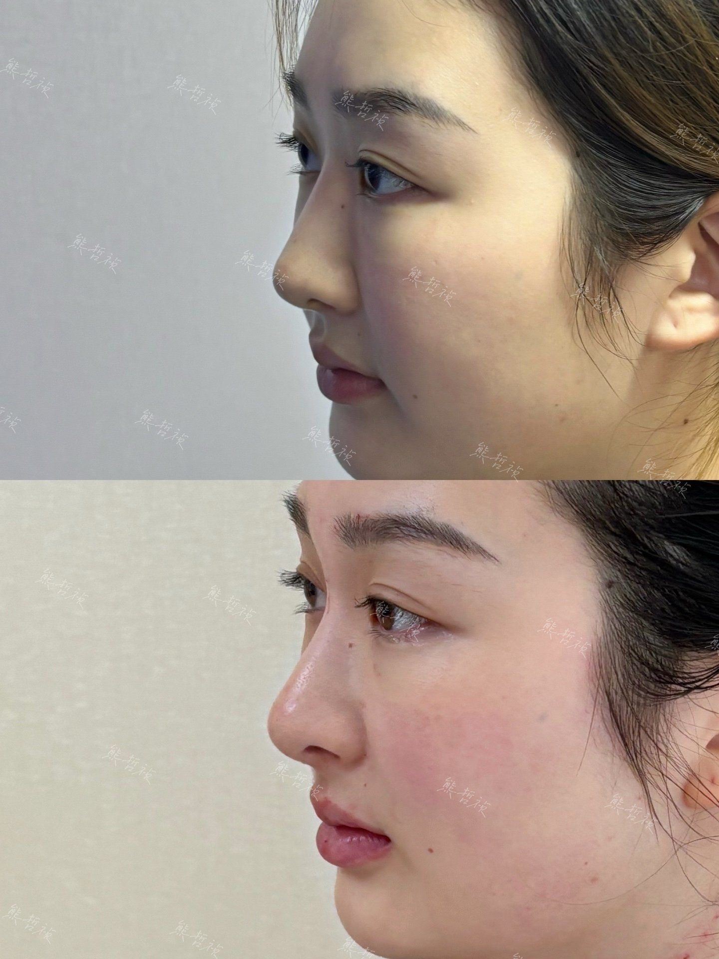 拒绝格格巫～

73从山根—鼻背—鼻头—鼻基底—鼻小柱,全方位