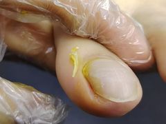 -祖传修脚甲沟炎灰指甲鸡眼