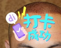 -大麦微针植发全国连锁