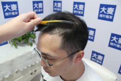 -大麦微针植发丨全国连锁