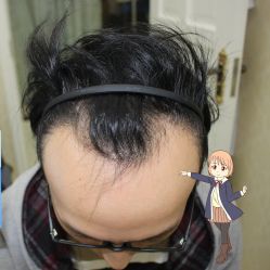 -大麦微针植发丨全国连锁